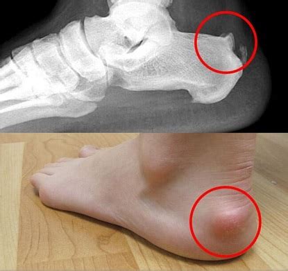 Haglunds Deformity: Causes, Symptoms & Treatment