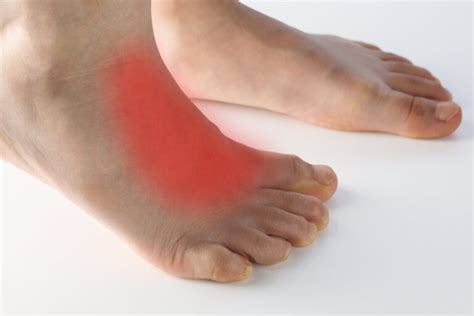 Arthritis on Top Of Foot? Remove the discomfort with this treatment