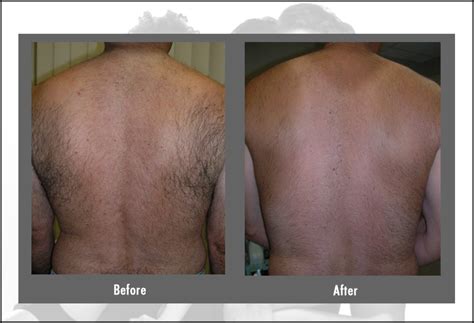 How Long Before Hair Falls Out After Laser Hair Removal at Ana Palmer blog