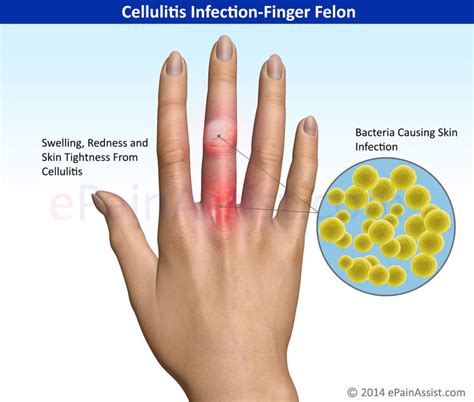 Cellulitis Skin Infection Symptoms | What is Cellulitis? | Synergy Research Center San Diego
