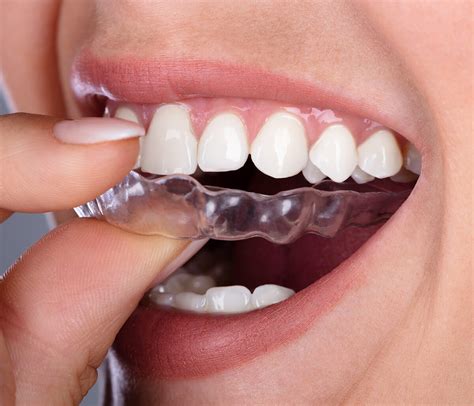 Dentist Shares Invisalign Clear Aligners Benefits Calgary