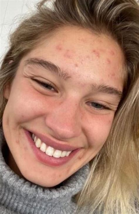 Model cures acne after year-long battle with bad skin | Photo | news.com.au — Australia’s ...