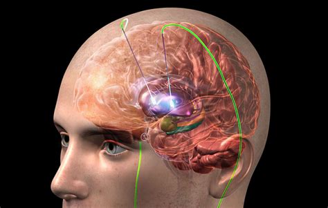 New Parkinson’s Treatment with Electrical Stimulation – Shop – Dr ...