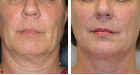 Non-Surgical Fat Reduction and Skin Tightening Procedures, Thermage and Exilis, Increase 200% at ...