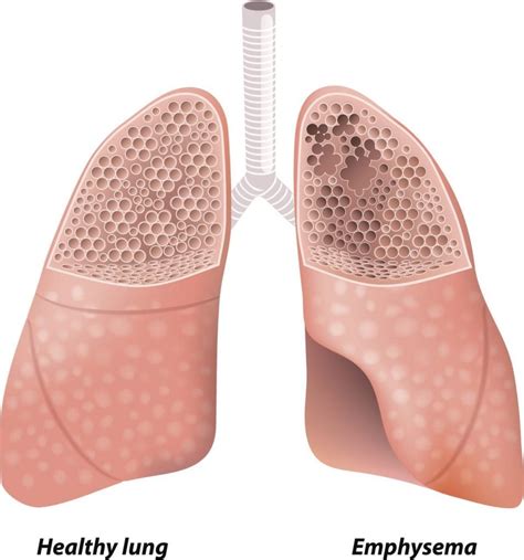 Stages Of Emphysema