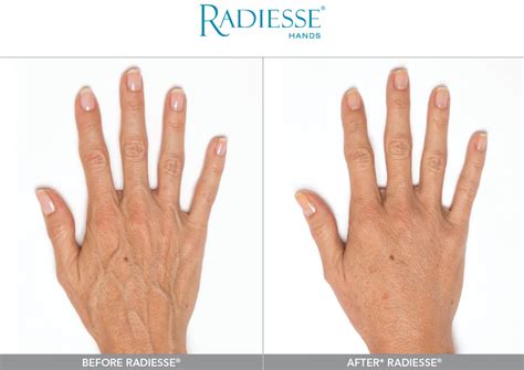 Radiesse for Hands Deal | Elemental Aesthetics