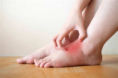 Red Rash With White Spots On Foot - Printable Templates Protal