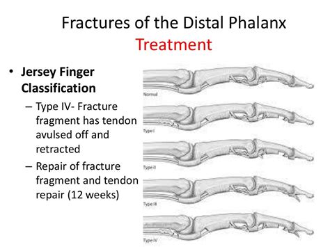 Distal phalanx fracture