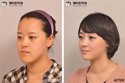 31 Crazy Before And After Photos Of Korean Plastic Surgery | Cirugía ...