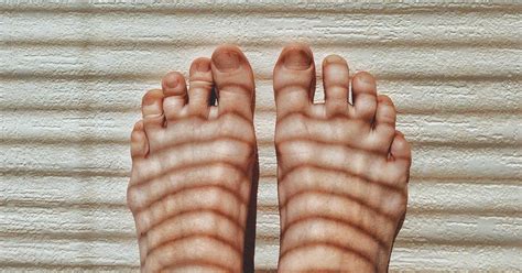 Red Toes: Symptoms, Causes, and Treatments