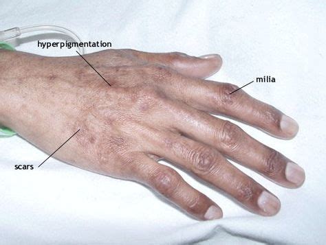 Typical Skin Disease in Porphyria Cutanea Tarda and Variegate Porphyria | Porphyria for Patients ...