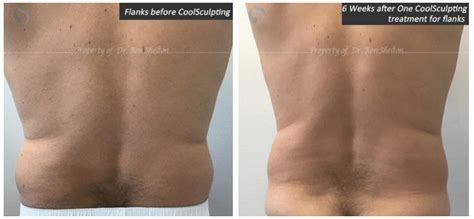 CoolSculpting Fat Reduction NYC | Coolsculpting flanks - Ron Shelton M.D