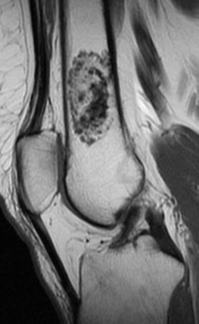 Enchondroma (MRI) | Radiology Case | Radiopaedia.org | radio | Radiology, Magnetic resonance ...