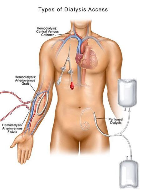 Temporary Hemodialysis Catheter