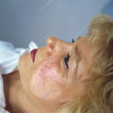 Cosmetic laser surgery - Stock Image - M590/0147 - Science Photo Library