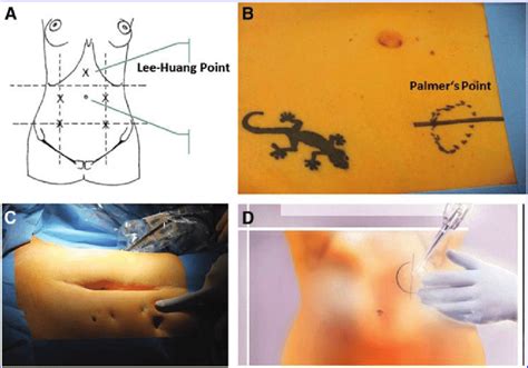 (A) The LeeHuang point can be palpated directly beneath the xiphoid.... | Download Scientific ...