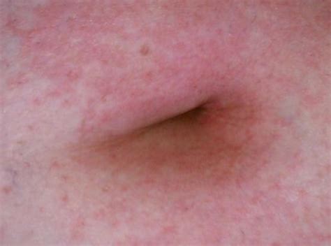 Belly button rash - causes, treatment, pictures