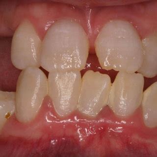 preoperative panoramic radiographs showing features of dentin dysplasia... | Download Scientific ...