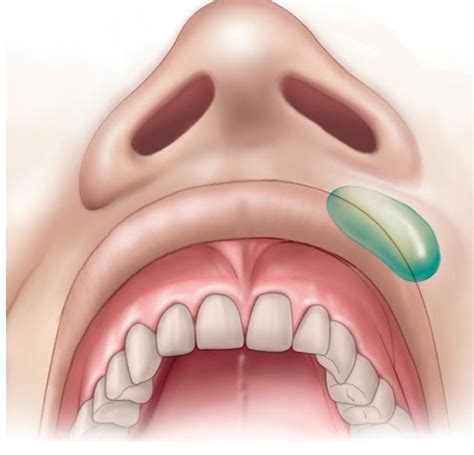 Dr. Bala: Nasolabial cyst / histopathology, clinical and radiographic ...