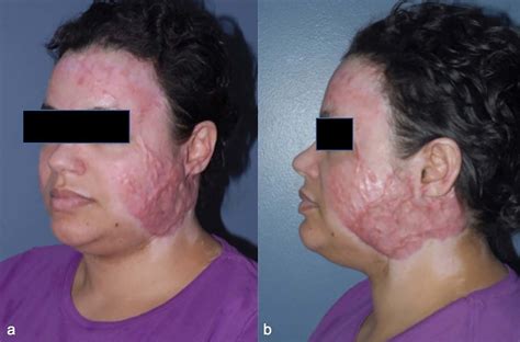 Case 4, a 36-year-old female sustained deep partial burns to her head ...