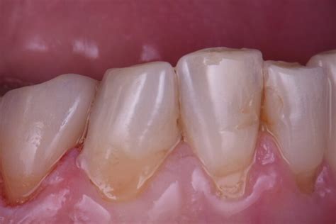 Cervical Abrasion Restorations Cervical Abrasion Restorations