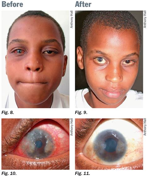 Treatment of predominantly unilateral severe limbal vernal… | Flickr