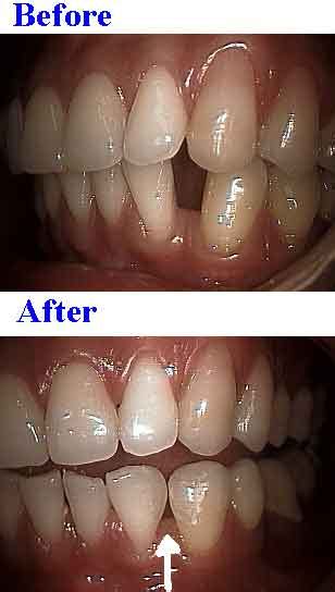 Bonding gaps between teeth with high end composite resins.