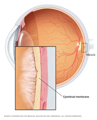 All About Epiretinal Membranes - Symptoms, Diagnosis & Treatment