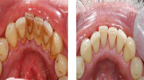 Plaque and Tartar Buildup - What is it? How can I Prevent it?