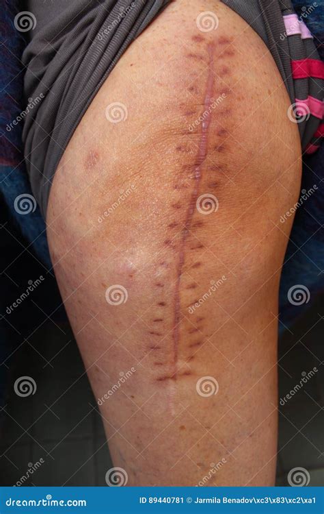 Operation Scar Of Achilles Tendon Rupture And Crutchs Stock Image ...