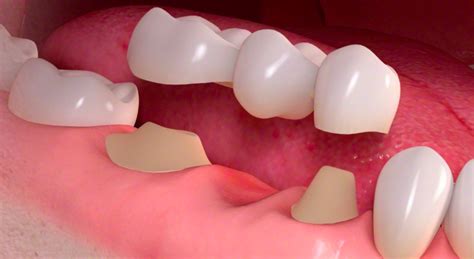 Fixed Partial Dentures