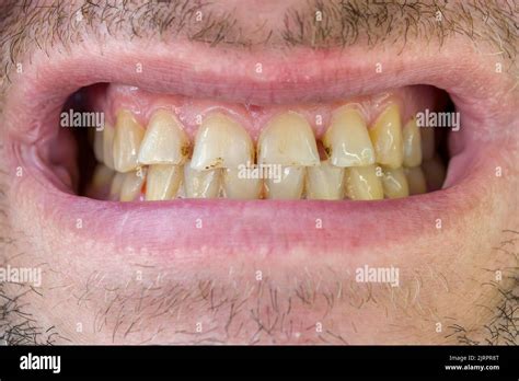 Ugly teeth of a man, crooked and dirty with plaque, close-up. Dentistry ...