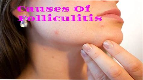 Folliculitis: What Is Folliculitis? Its Symptoms, Causes, And More