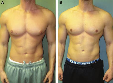 Bodybuilder Gynecomastia