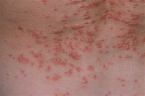 Scabies Rash photos: Symptoms, Causes, and Treatment methods