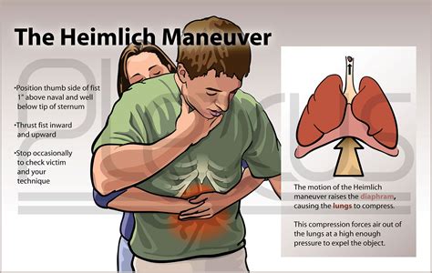 Heimlich Maneuver - Plexus Medical Art, LLC | Heimlich maneuver ...