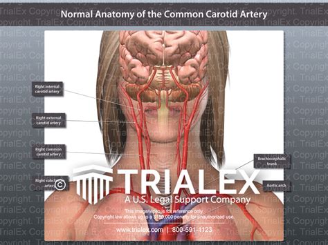Normal Anatomy of the Common Carotid Artery - TrialExhibits Inc.