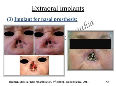 Classification and Types of Craniofacial Implants