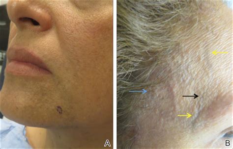 Frontal Fibrosing Alopecia: Cutaneous Associations in Women With Skin of Color | MDedge Dermatology