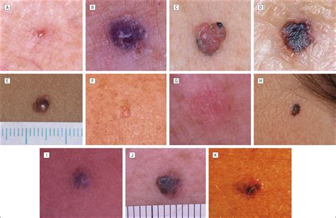 Nodular Malignant Melanoma