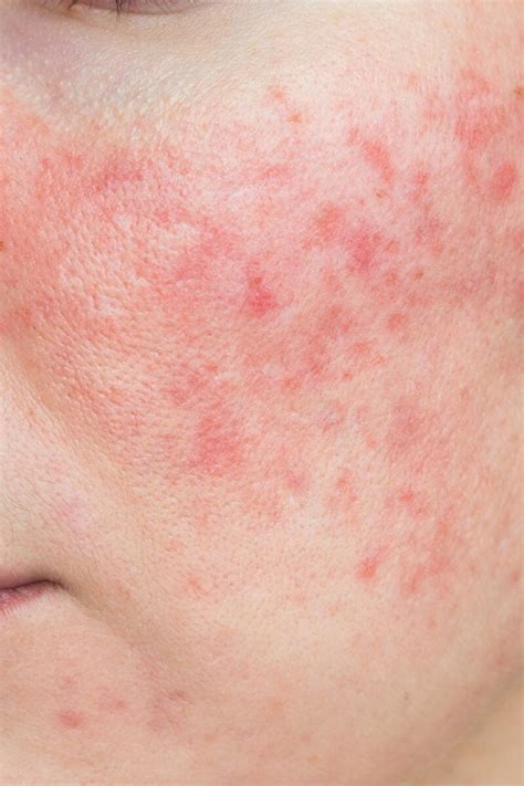 What to Know About Papulopustular Rosacea