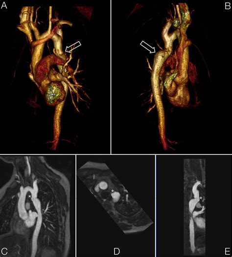 Diagnosis, imaging and clinical management of aortic coarctation | Heart