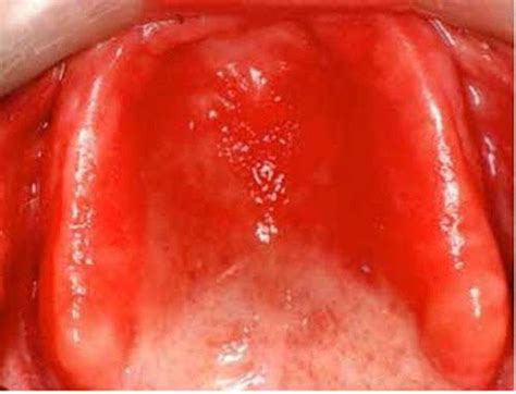 Symptoms of denture stomatitis - MEDizzy