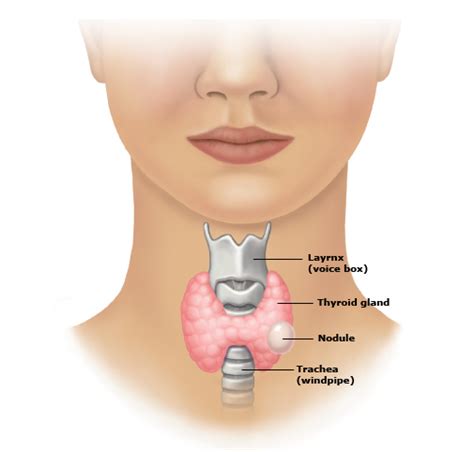 Lump In Throat Thyroid