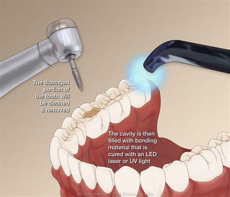 Tooth Cavity Filling Before And After