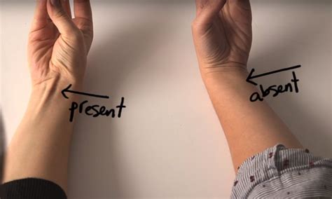 Palmaris Longus Test