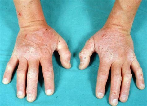 Dermatitis herpetiformis causes, symptoms, diagnosis and treatment