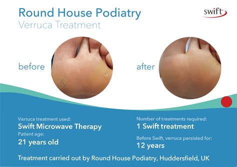 How long does it take to get rid of a verruca? Some Swift Case Studies ...