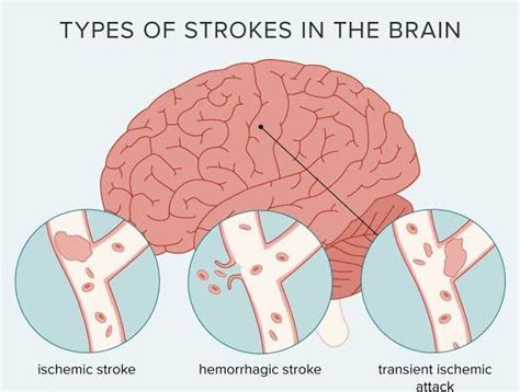 Types of strokes - MEDizzy