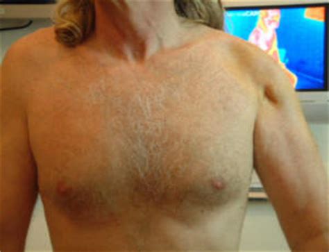 Atrophy of shoulder muscle - Arthritis USA - The Center for Regenerative Medicine